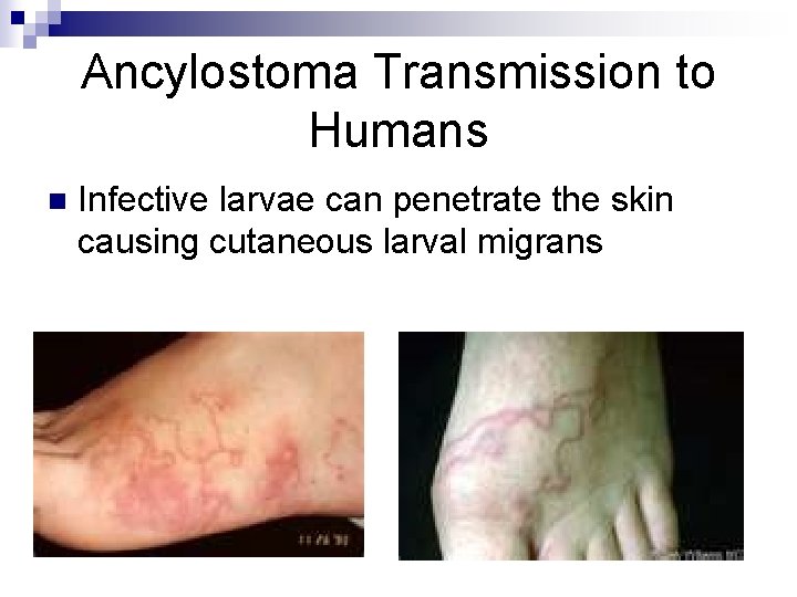 Ancylostoma Transmission to Humans n Infective larvae can penetrate the skin causing cutaneous larval