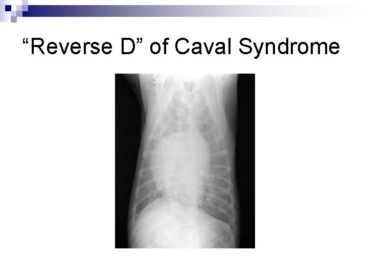 “Reverse D” of Caval Syndrome 