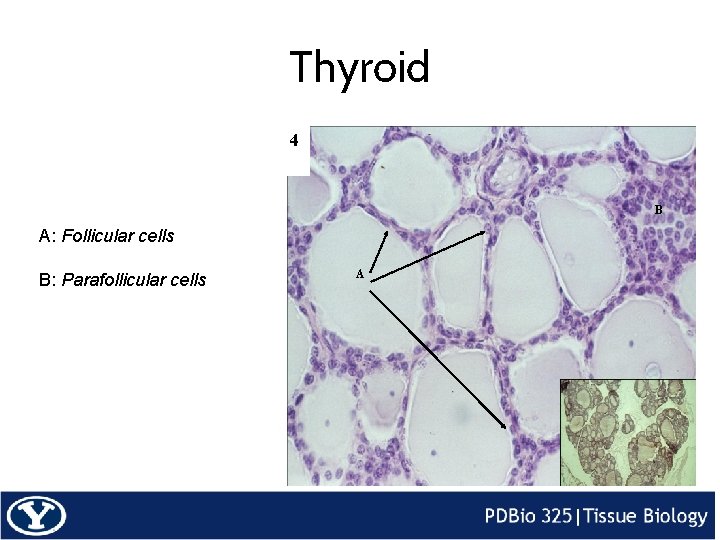 Thyroid 4 B A: Follicular cells B: Parafollicular cells A 