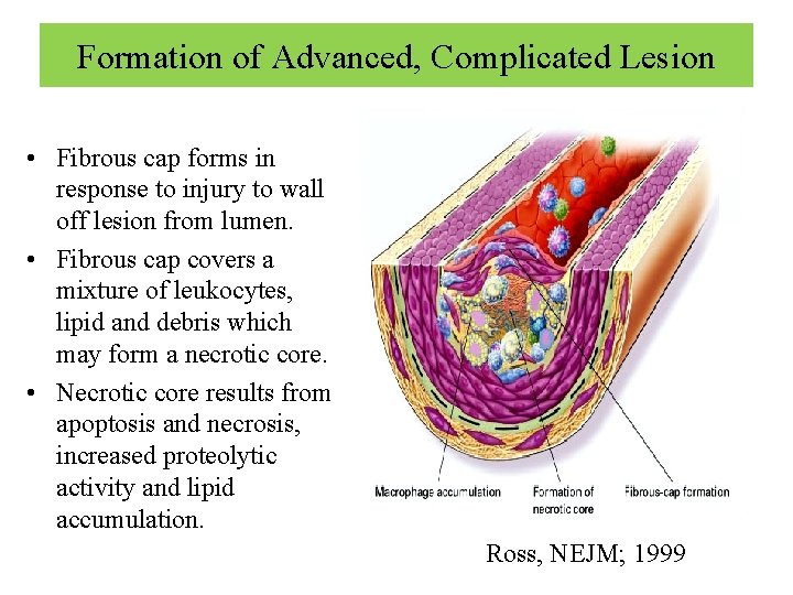 Formation of Advanced, Complicated Lesion • Fibrous cap forms in response to injury to