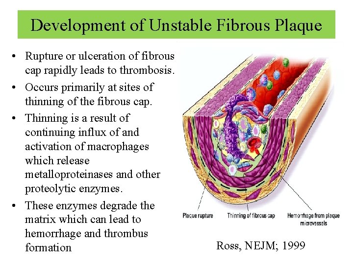 Development of Unstable Fibrous Plaque • Rupture or ulceration of fibrous cap rapidly leads