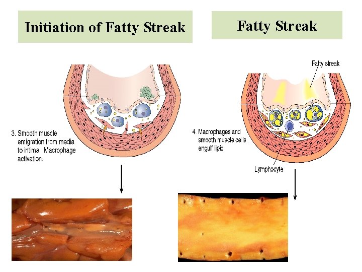 Initiation of Fatty Streak 