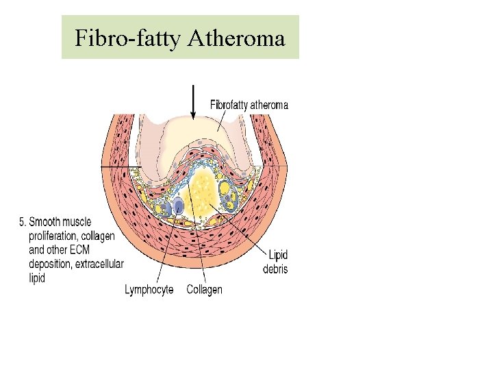 Fibro-fatty Atheroma 