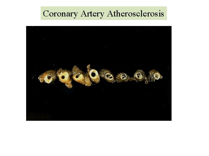 Coronary Artery Atherosclerosis 