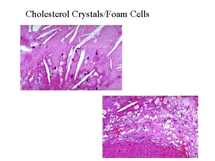 Cholesterol Crystals/Foam Cells 