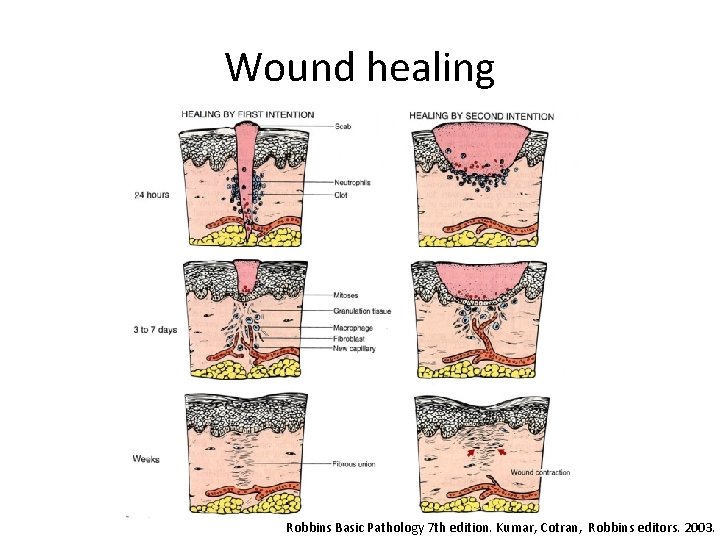 Wound healing Robbins Basic Pathology 7 th edition. Kumar, Cotran, Robbins editors. 2003. 