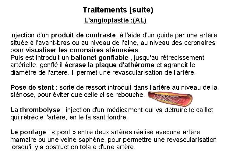 Traitements (suite) L'angioplastie : (AL) injection d'un produit de contraste, à l'aide d'un guide