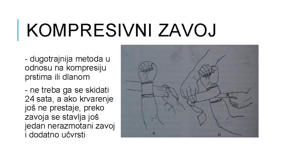 KOMPRESIVNI ZAVOJ - dugotrajnija metoda u odnosu na kompresiju prstima ili dlanom - ne