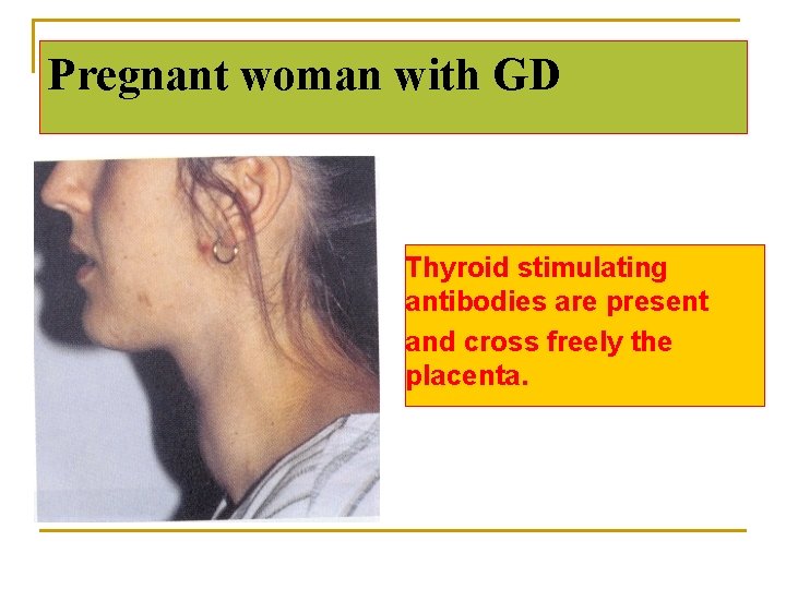 Pregnant woman with GD Thyroid stimulating antibodies are present and cross freely the placenta.