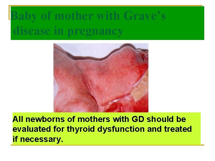 Baby of mother with Grave’s disease in pregnancy All newborns of mothers with GD