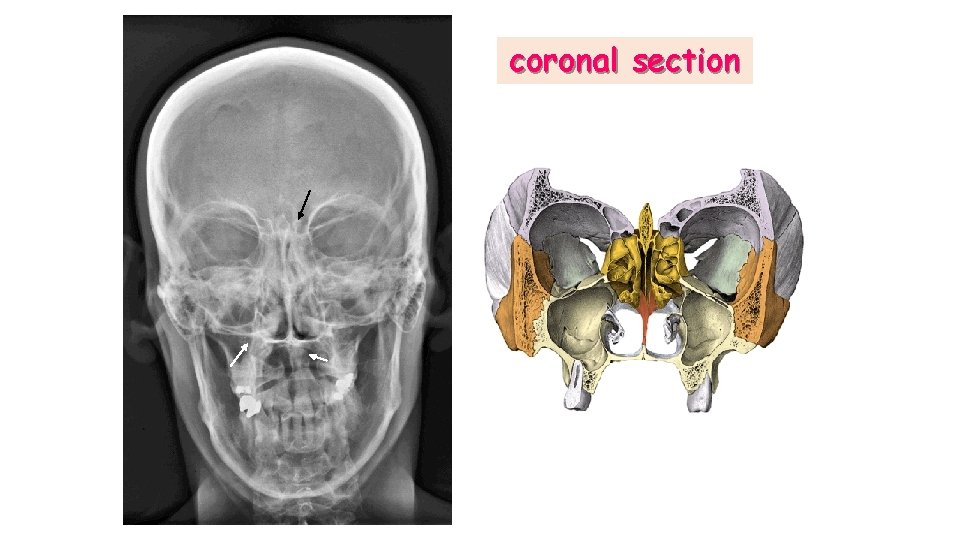 coronal section 