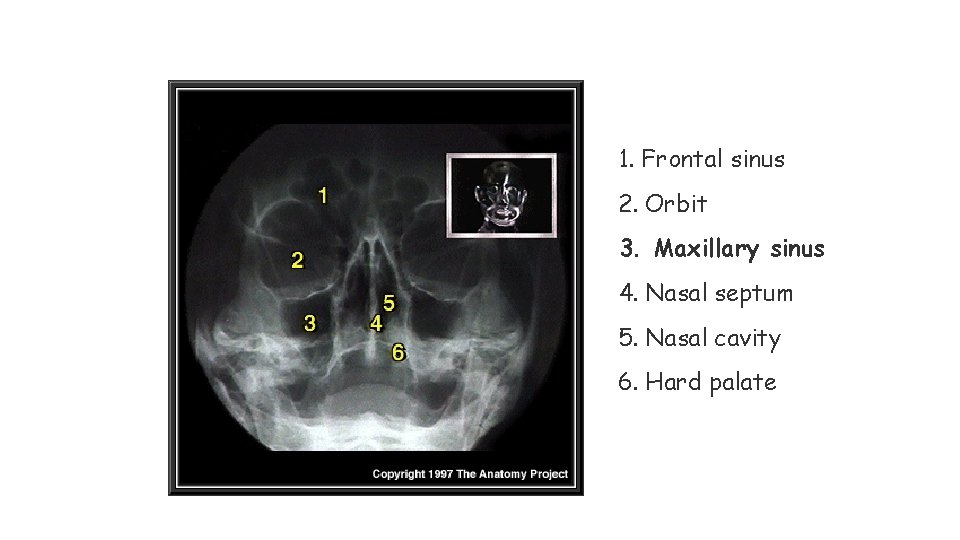 1. Frontal sinus 2. Orbit 3. Maxillary sinus 4. Nasal septum 5. Nasal cavity 1. Frontal sinus 2. Orbit 3. Maxillary sinus 4. Nasal septum 5. Nasal cavity