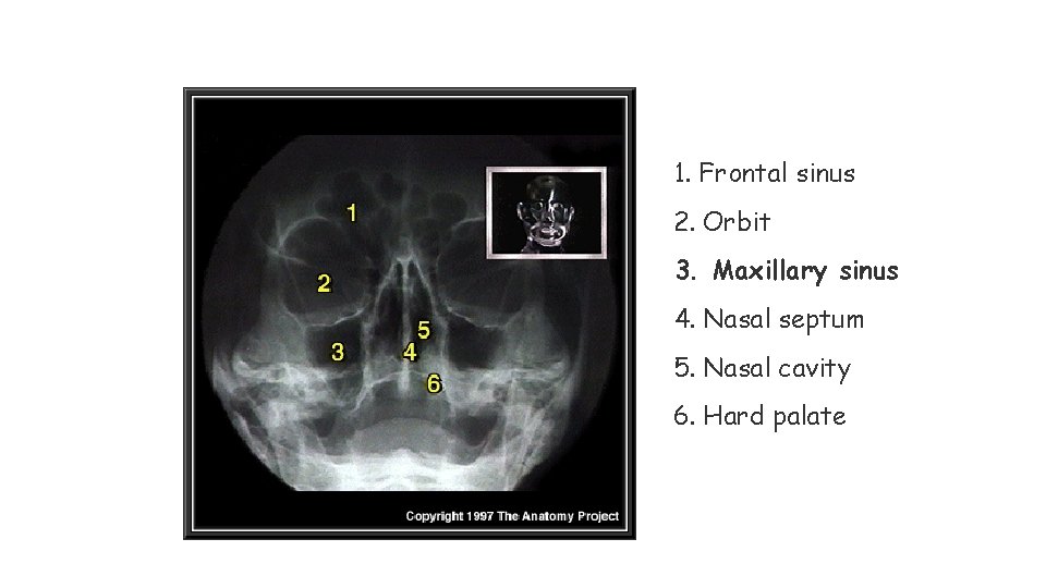 1. Frontal sinus 2. Orbit 3. Maxillary sinus 4. Nasal septum 5. Nasal cavity