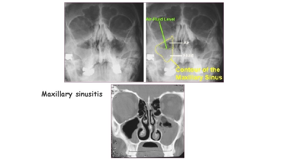 Maxillary sinusitis Maxillary sinusitis