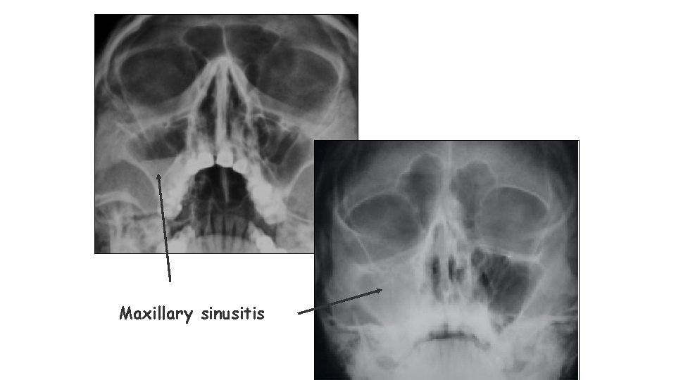 Maxillary sinusitis 