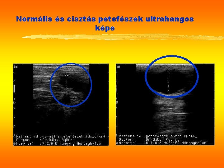 Normális és cisztás petefészek ultrahangos képe 