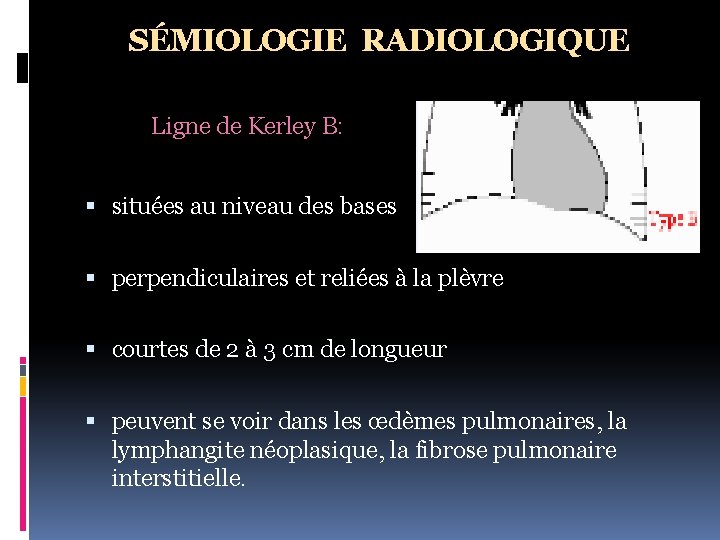 SÉMIOLOGIE RADIOLOGIQUE Ligne de Kerley B: situées au niveau des bases perpendiculaires et reliées