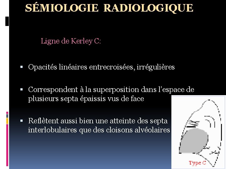 SÉMIOLOGIE RADIOLOGIQUE Ligne de Kerley C: Opacités linéaires entrecroisées, irrégulières Correspondent à la superposition