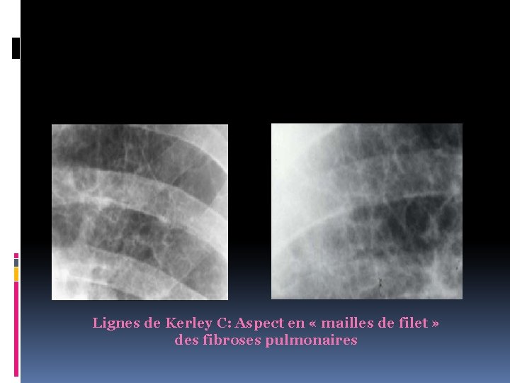 Lignes de Kerley C: Aspect en « mailles de filet » des fibroses pulmonaires