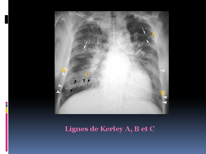 Lignes de Kerley A, B et C 