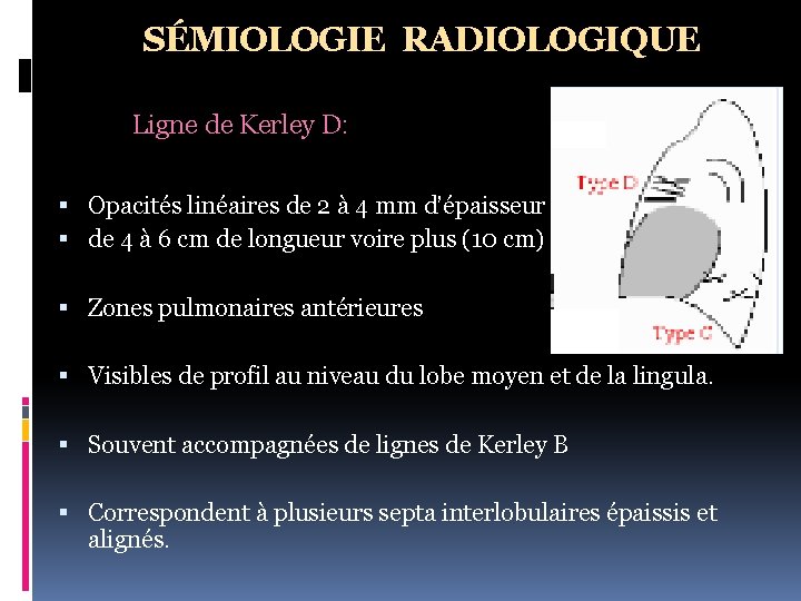 SÉMIOLOGIE RADIOLOGIQUE Ligne de Kerley D: Opacités linéaires de 2 à 4 mm d’épaisseur