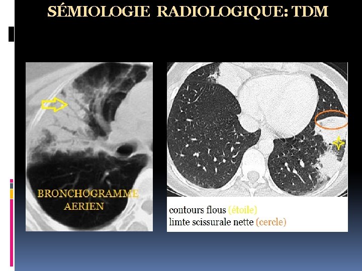 SÉMIOLOGIE RADIOLOGIQUE: TDM 