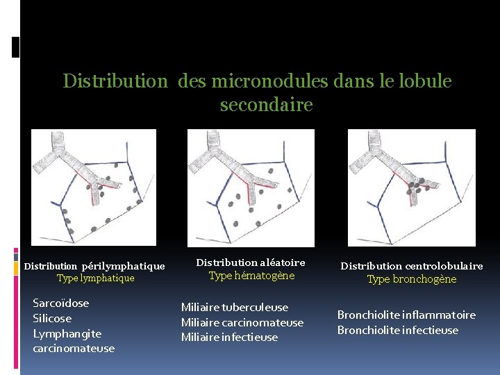 Distribution des micronodules dans le lobule secondaire Distribution périlymphatique Type lymphatique Sarcoïdose Silicose Lymphangite