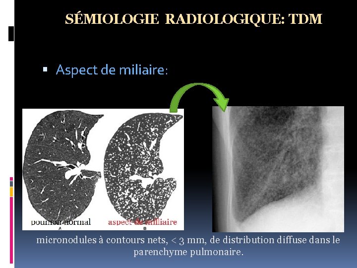 SÉMIOLOGIE RADIOLOGIQUE: TDM Aspect de miliaire: micronodules à contours nets, < 3 mm, de