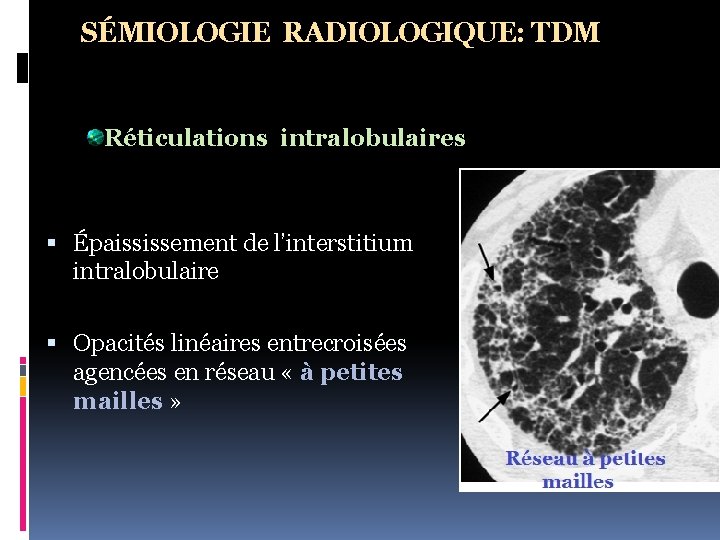 SÉMIOLOGIE RADIOLOGIQUE: TDM Réticulations intralobulaires Épaississement de l’interstitium intralobulaire Opacités linéaires entrecroisées agencées en