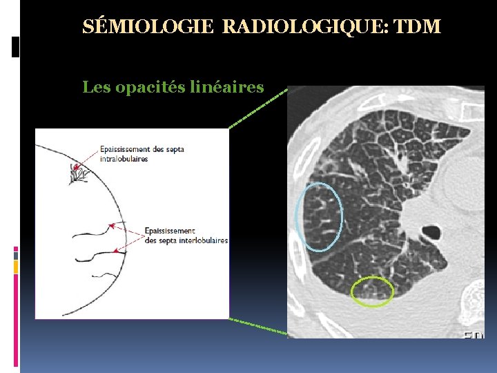 SÉMIOLOGIE RADIOLOGIQUE: TDM Les opacités linéaires 