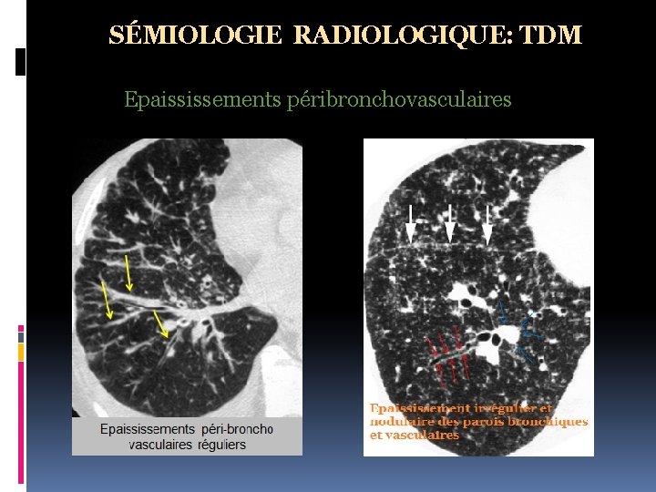 SÉMIOLOGIE RADIOLOGIQUE: TDM Epaississements péribronchovasculaires 