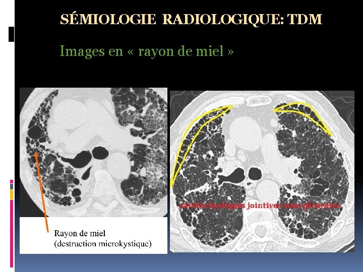 SÉMIOLOGIE RADIOLOGIQUE: TDM Images en « rayon de miel » 