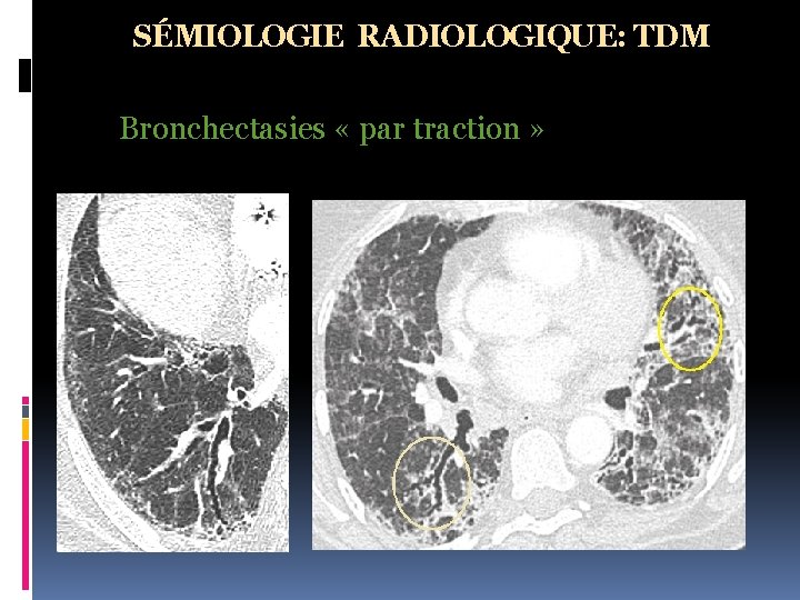 SÉMIOLOGIE RADIOLOGIQUE: TDM Bronchectasies « par traction » 