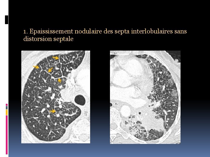 1. Epaississement nodulaire des septa interlobulaires sans distorsion septale 