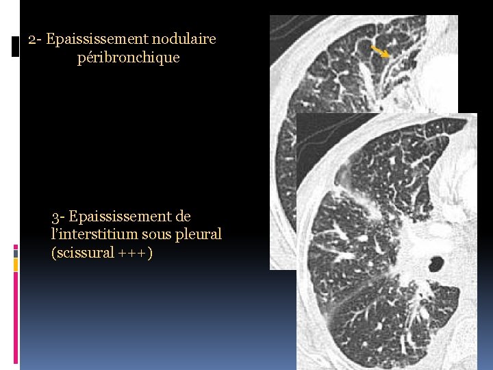 2 - Epaississement nodulaire péribronchique 3 - Epaississement de l’interstitium sous pleural (scissural +++)