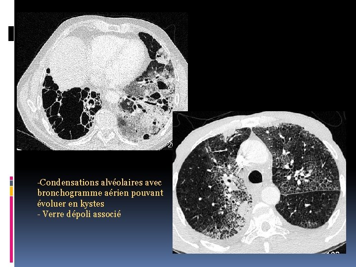 -Condensations alvéolaires avec bronchogramme aérien pouvant évoluer en kystes - Verre dépoli associé 