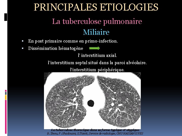 PRINCIPALES ETIOLOGIES La tuberculose pulmonaire Miliaire En post primaire comme en primo-infection. Dissémination hématogène