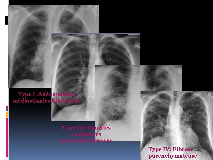 Type I : Adénopathies médiastinales bilatérales Type III: Opacités nodulaires parenchymateuses Type IV: