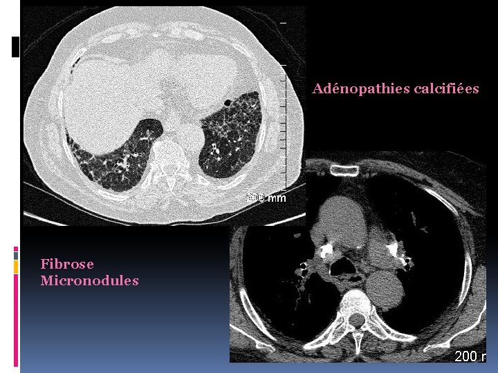 Adénopathies calcifiées Fibrose Micronodules 
