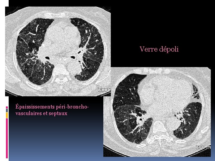 Verre dépoli Épaississements péri-bronchovasculaires et septaux 