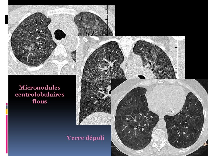 Micronodules centrolobulaires flous Verre dépoli 