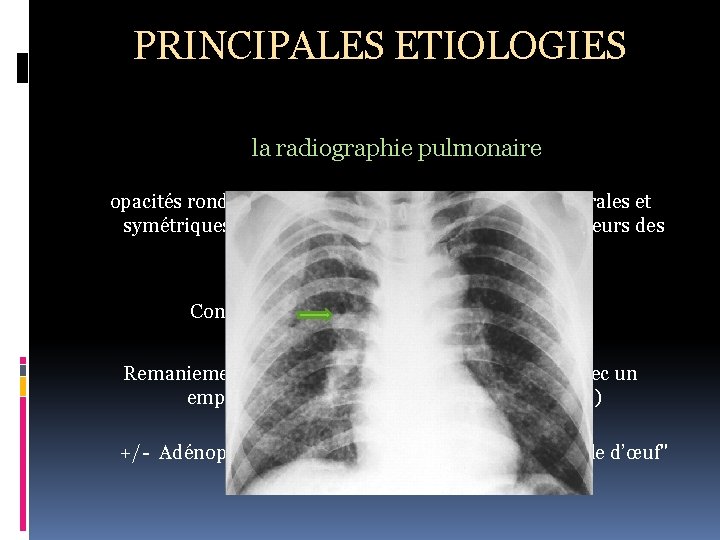 PRINCIPALES ETIOLOGIES la radiographie pulmonaire opacités rondes, micronodulaires ou nodulaires, bilatérales et symétriques, prédominant