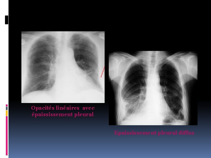 Opacités linéaires avec épaississement pleural Epaississement pleural diffus 