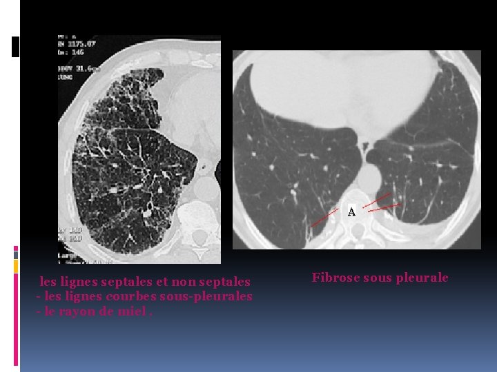  les lignes septales et non septales - les lignes courbes sous-pleurales - le