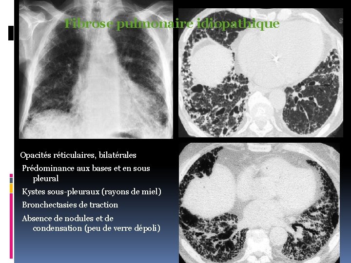 Fibrose pulmonaire idiopathique Opacités réticulaires, bilatérales Prédominance aux bases et en sous pleural Kystes