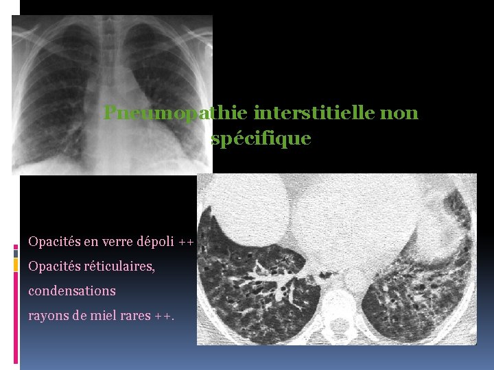 Pneumopathie interstitielle non spécifique Opacités en verre dépoli ++ Opacités réticulaires, condensations rayons de
