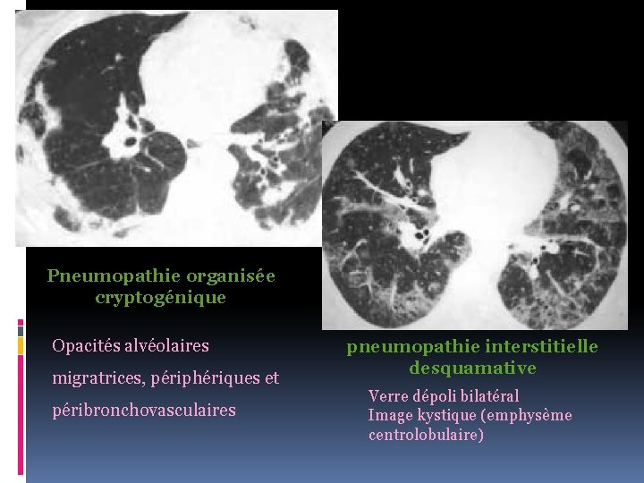 Pneumopathie organisée cryptogénique Opacités alvéolaires migratrices, périphériques et péribronchovasculaires pneumopathie interstitielle desquamative Verre dépoli