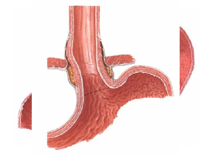 Stomach – wall structure • tunica mucosa – plicae gastricae (sulcus salivatorius Waldeyeri) areae