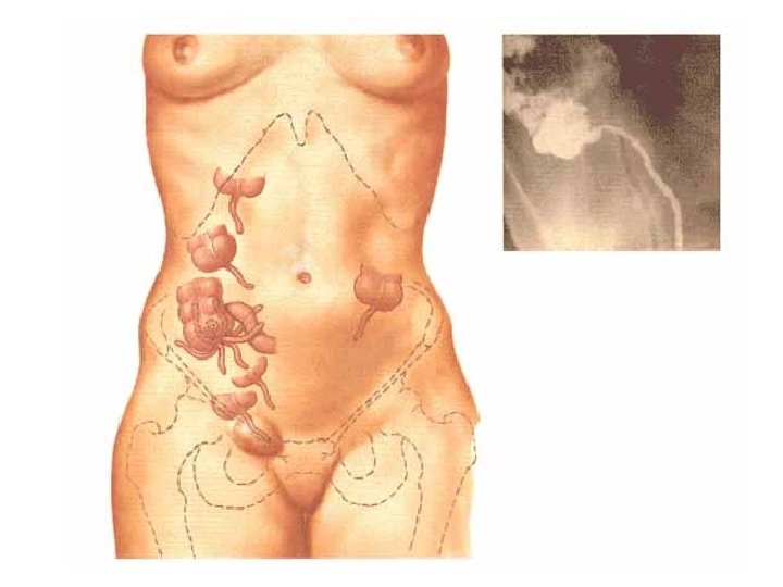 Appendix vermiformis caeci • Paneth cells are present • lamina propria mucosae – fulfilled