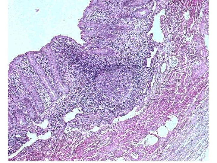 Appendix vermiformis - HE 